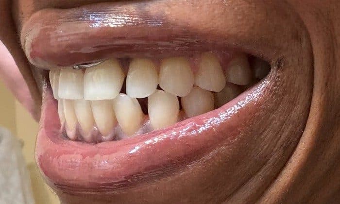 Side view of crowded teeth