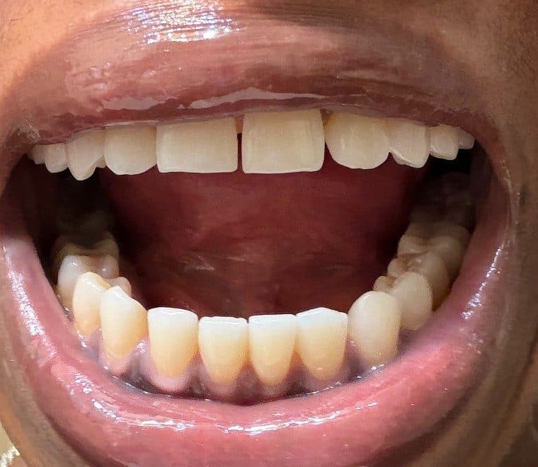 Open mouth showing lower teeth