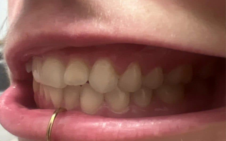 Side view of the bite