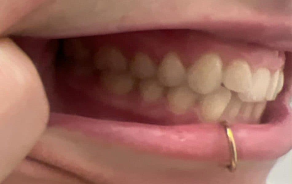 Side view of the teeth