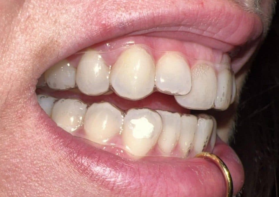 Wearing aligners with attachments