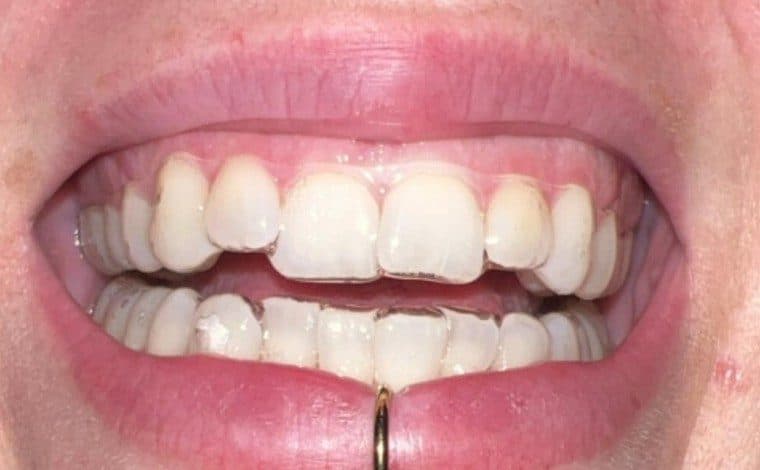 Smile while wearing aligners