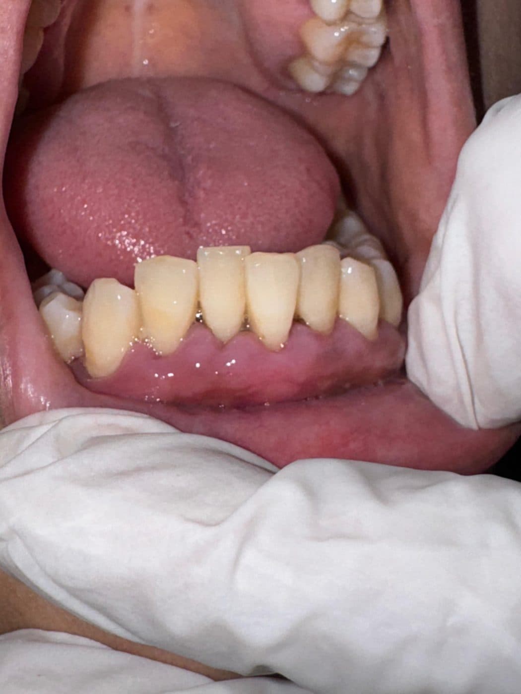 Lower front teeth