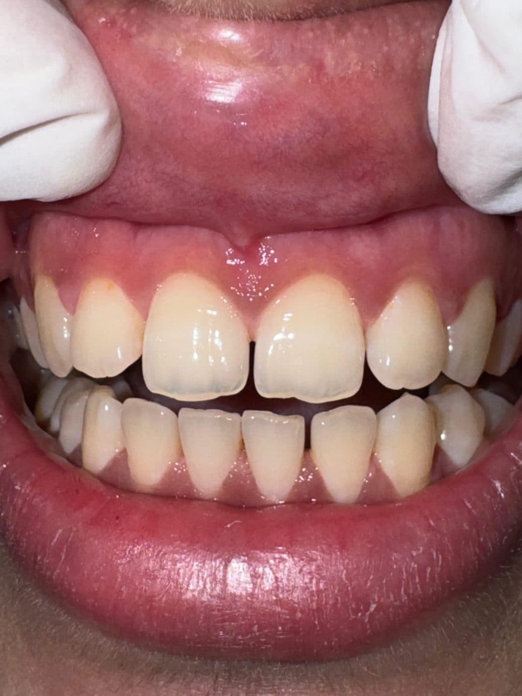 Front view of the teeth
