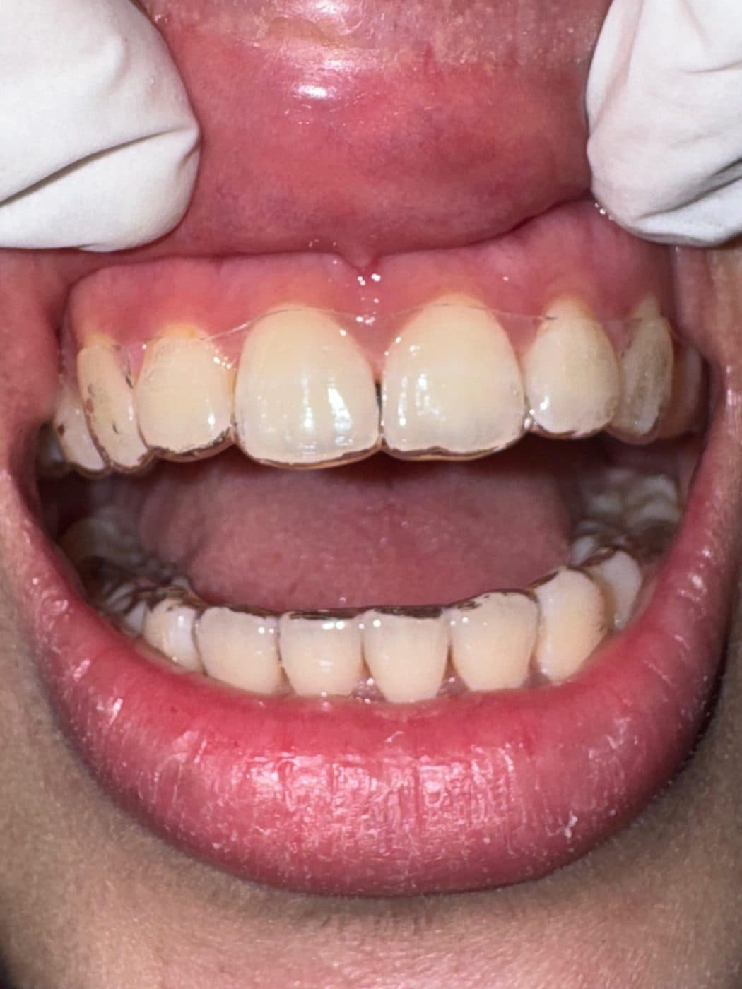Wearing clear aligners