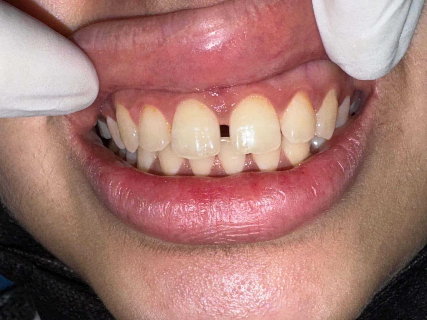 Smile showing a gap between the upper front teeth